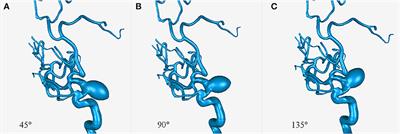 Quantitative Assessment of Changes in Hemodynamics After Obliteration of Large Intracranial Carotid Aneurysms Using Computational Fluid Dynamics